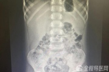 5歲男孩誤食3厘米長氣釘 徐醫附院多學科協作合力取出